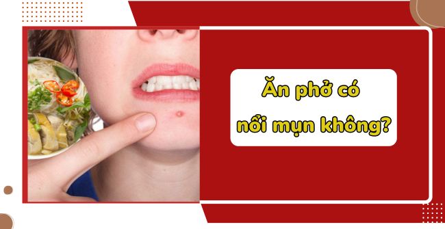 Ăn phở có nổi mụn không?